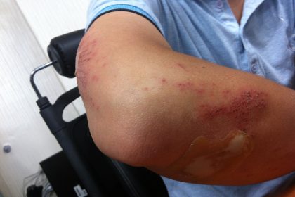 LESIONES EN EL CUERPO
